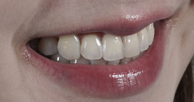 治療後笑起來，門牙的縫不見了，自然不做作