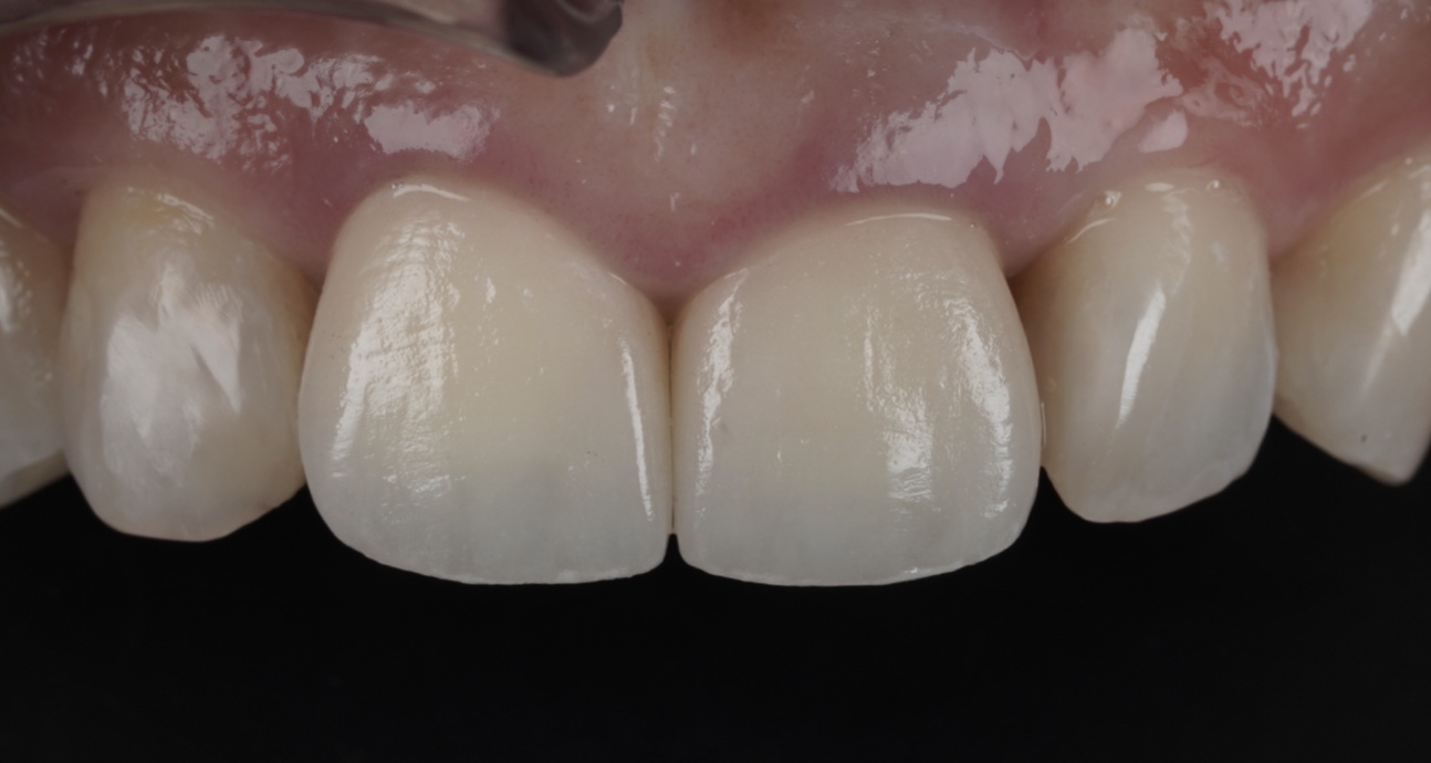 顯微女孩-14 術後