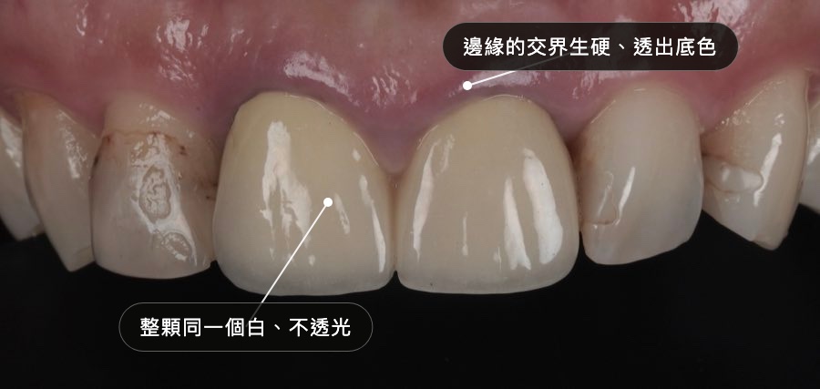 全瓷冠色差的反例標註圖：整顆同一個白不透光、邊緣交界生硬透出底色（拆掉重做前的舊假牙）