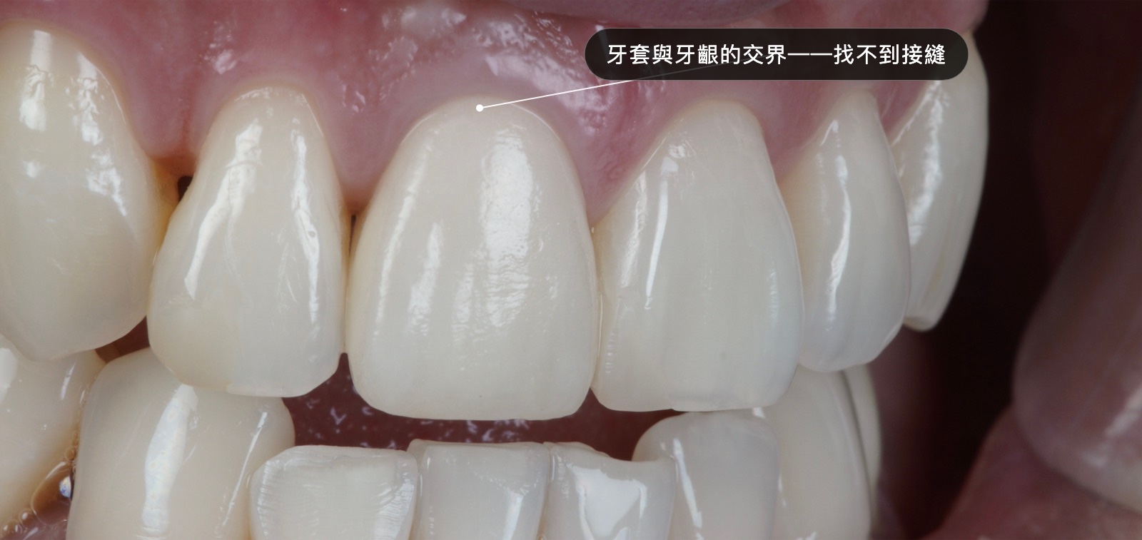 全瓷冠邊緣標註圖：牙套與牙齦的交界密合、找不到接縫